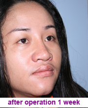 plastic_surgery_augmentation_rhinoplasty